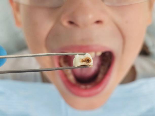 Best Dentist for Tooth Abscess  in Everett, WA